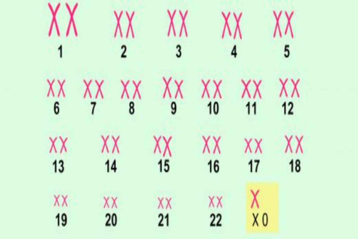 Sindrome De Turner Cromosoma