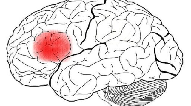 Afasia de Broca síntomas y causas