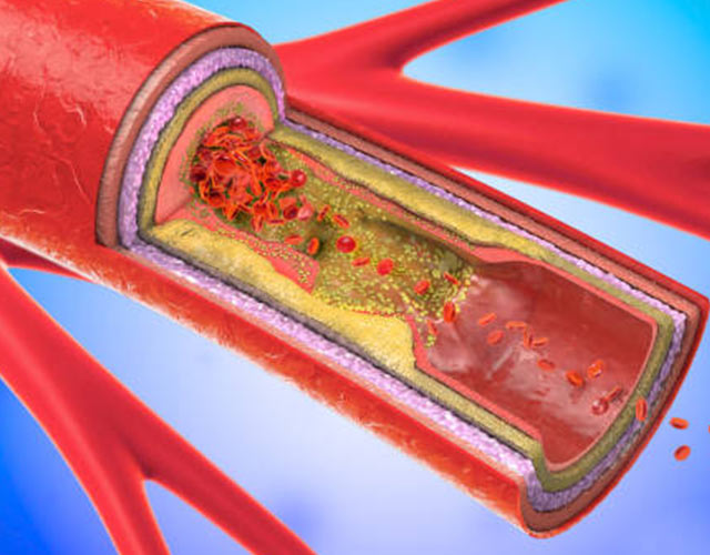 Arterioesclerosis: Causas, Síntomas Y Tratamiento