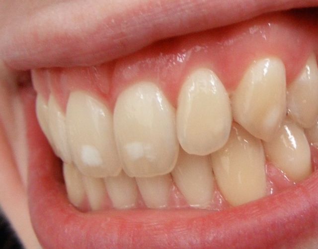 Fluorosis dental: Causas y tratamiento